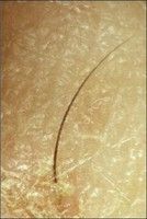 薄毛治療に光明？ 発毛を促す「たんぱく質コード遺伝子」発見 - 英国