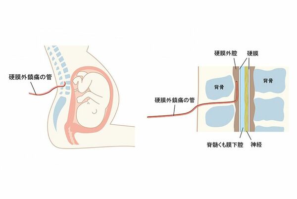 硬膜外麻酔の仕組み。図のように背骨の神経を包むように守っている硬膜の外側に薬液を注入する。出典:日本産科麻酔学会
